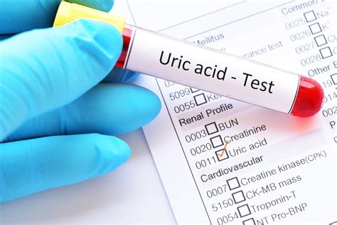 uric acid blood test bottle colour|uric acid lab code chart.